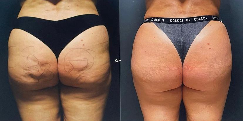 Before and after Advanced Cellulite Goldincision